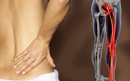 Đau dây thần kinh tọa và những điều cần biết