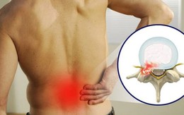 Thoát vị đĩa đệm ở người trẻ và những điều cần lưu ý